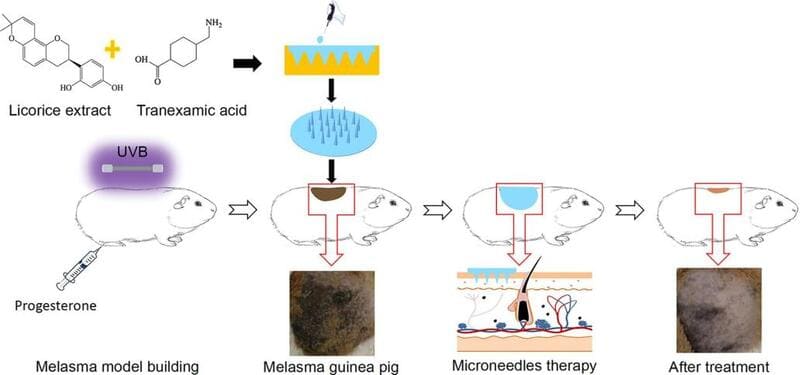 Preparation of Tranexamic Acid-Containing Soluble Microneedle (DMNs) Patches